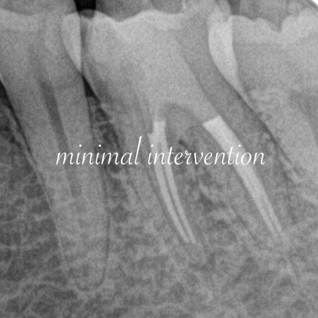 MI（minimal intervention）
歯にとって最小限の侵襲、最小限の切削量により治療をするということ。

根管治療においても、マイクロスコープ、CT、NiTiファイルなどの使用によりMIのコンセプトに基づく歯の保存が可能となってきました。

治療に必要な最小限の上部形成に留め、十分な根管洗浄、根管充填を行います。

MIの考え方と同時に、必要な機材を適切に使い、機械的形成、化学的洗浄を十分に行うことが、根管治療成功の鍵であると考えます。