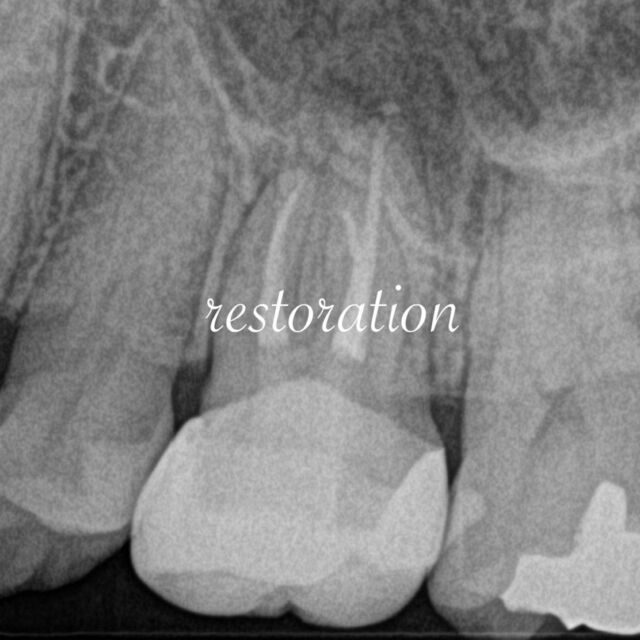 適切な根管治療を行ってもrestoration（歯の修復処置）が適切に行われてなければ、抜歯の一因となります。

各ステップにおいて、マイクロリーケージや、歯根破折などに配慮した修復処置が重要です。