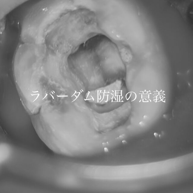 clara dental clinicです𓂃𓈒𓏸 

患歯を口腔内から分離し、無菌的環境下にて治療を行うためには「ラバーダム防湿」が必須となります。

細菌感染の防止以外にも、いくつかの意義がありますので、ご一度頂けると幸いです。

#無菌的処置　#bacterialreduction #クラスb滅菌器