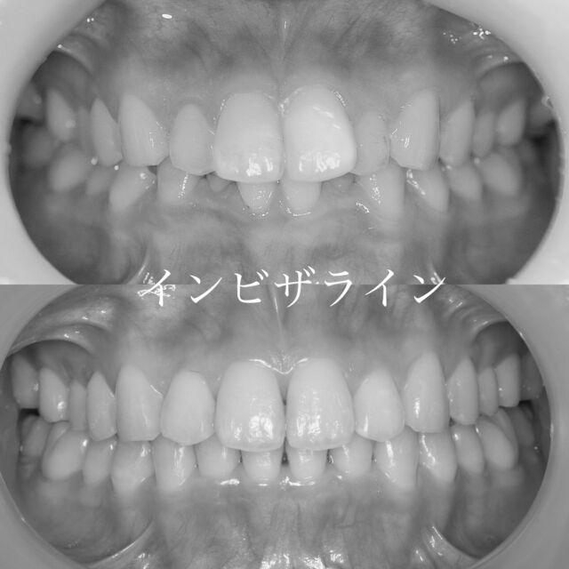 clara dental clinic です𓂃 𓈒𓏸

インビザライン矯正の症例

前歯と咬み合わせが気になる、と言うことを主訴に来院された患者様です。

矯正期間は1年🦷✨

費用: 約880,000円（症例により変わります）
利点: 痛みが少ない
  目立たない
欠点: 使用時間を守らない 
  場合動かない

詳しくはプロフィール画面よりHPをご確認下さい。

✼••┈┈┈┈┈┈┈┈┈┈┈┈┈┈┈┈••✼
　˖* clara dental clinic
　福岡県北九州市小倉北区大門1-13-3
　093-967-0410

˖* アクセス
　西小倉駅から歩いて5分
　大門のバス停より歩いて1分

˖* お問合せ・ご予約
　プロフィール画面よりお願いします
✼••┈┈┈┈┈┈┈┈┈┈┈┈┈┈┈┈••✼

#invisaline #invisalignfirst #invisalignteen 
#矯正 #インビザライン #インビザライファースト #小倉北区 #歯科 #西小倉
 #大門