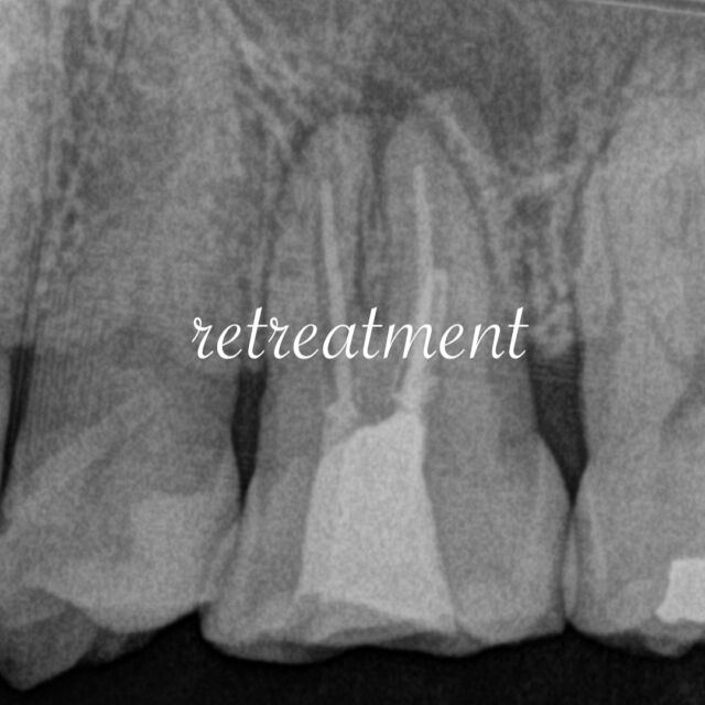 根管のリトリートメントについて𓂃 𓈒𓏸 

FGM Gorniらによると、この症例のように根管形態が維持できている場合の根管再治療の成功率は87%であるということが示されています。　

その他、予後因子をこの症で考えてみた場合、5mm以上の病変がある場合の成功率66%というデータもあります。

また、術中・術後の因子として、根管充填位置が適切であった場合は80%であるのに対し、オーバー充填は63%、また修復物が良好な場合80%であるのに対し、不良な場は60%の成功率であるとの報告も🦷❤

この成功率66%を上げるために私たちができるのは、感染部へのアクセス確保、適切な根管形成と消毒、適切な長さでの緊密な根管充填、また良好な最終修復物による歯冠側の封鎖です。

#リトリート #再治療 #根管治療 #マイクロエンド #北九州