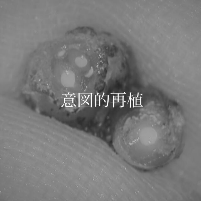 ・
・
遠心ポケット12㍉、遠心に瘻孔を繰り返しているという、エンドペリオでしたが、エンド由来であると期待して意図的再植を試みました。

現在のところ、予後不良の症状もなく患者様には満足いただけています。

「意図的再植」

歯内療法の一つの治療選択肢で、外科的歯内療法（歯根端切除術）が困難な部位の歯（オトガイ孔が近くの下顎5番や7番など）に行われる術式です。

問題のある歯を一度抜歯し、口腔外で根尖部の処置を行った後、同じ歯槽窩（抜歯窩）に再び戻す治療法です。

歯根膜の損傷を避けて抜歯、歯根膜の生活力を維持するために口腔外での処置は10分以内に留めることが重要。

𓏸𓈒𓂃clara dental clinic𓂃𓈒𓏸 

⧉住所
福岡県北九州市小倉北区大門1-3-13

⧉診療日
月火木金土(土曜日はAMのみ)

⧉診療時間
AM 9:00〜13:00
PM 14:30〜18:30

#根管治療 #精密根管治療 #根管治療専門 #マイクロエンド #歯内治療 #北九州 #小倉北区 #意図的再植
