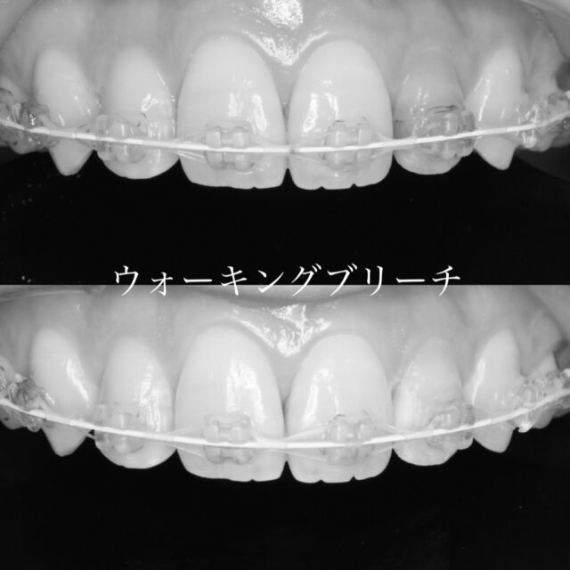 ・
・
🦷✨ウォーキングブリーチ✨
神経を取った歯が黒ずんできた…
そんな時に行うのが、歯の内側から白くする治療です。

歯を削りすぎることなく、
ご自身の歯をできるだけ残したまま
自然な白さを取り戻せるのが特徴🌿

「被せ物にする前に、まずは白くできないか？」
そんな選択肢として知っていただけたら嬉しいです😊
　
ウォーキングブリーチのリスク・注意点

⚠️ 効果には個人差があります
変色の原因や歯の状態により、白くなる程度や回数は異なります。

⚠️ 後戻りする可能性があります
時間の経過とともに色が戻ることがあります。

⚠️ 被せ物・詰め物は白くなりません
天然歯のみが対象となります。

⚠️ 歯の状態によっては適応できない場合があります
ヒビがある歯、歯質が薄い場合などは
他の治療法をご提案することがあります。

⚠️ まれに外部歯根吸収が起こる可能性があります
特に歯の状態や既往によっては、
慎重な診査・経過観察が必要です。

費用について 🦷

💰 ウォーキングブリーチは自費診療です

🔹 1回目
・1本：8,800円（税込）
・2本目以降：＋2,200円（税込）／本

🔹 2回目以降
・3,300円（税込）／本

※歯の状態や変色の程度により、
　必要な回数は異なります
※診査・ご説明の上で治療を行います

#ウォーキングブリーチ #歯の変色 #失活歯のホワイトニング #精密根管治療 #北九州