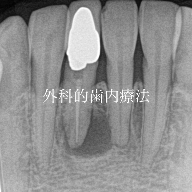 ・
・
🦷 外科的歯内療法（歯根端切除術）症例
⠀
「抜くしかない」と言われた歯でも、
🩺 適切な診断
🔬 丁寧な処置
で、残せる可能性があります。
⠀
根尖部の病変を除去し、
✨ 逆根管充填を行いました。
⠀
📅 36m follow-up
疼痛・症状なく、
🦴 良好な骨治癒を確認しています。

𓏸𓈒𓂃 clara dental clinic 🦷𓂃𓈒𓏸

やさしく、丁寧に。
お一人おひとりに寄り添う歯科診療を大切にしています。

⧉ Address
福岡県北九州市小倉北区大門1-3-13

⧉ Open days
Mon / Tue / Thu / Fri / Sat
※Saturday AM only

⧉ Hours
AM 9:00 – 13:00
PM 14:30 – 18:30

⧉ Closed
Wed / Sun / Holidays

#精密根管治療  #外科的歯内療法　#歯根端切除術 #apicoectomy #北九州