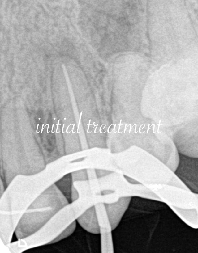 ・
・
CBCTで根尖病変が偶然発見されることがあります。

矯正治療後、他の歯の治療でご依頼をいただいた患者様です🦷

治療歴のない歯に病変ができる理由って何なのでしょう😳

𓏸𓈒𓂃 clara dental clinic 🦷𓂃𓈒𓏸

やさしく、丁寧に。
お一人おひとりに寄り添う歯科診療を大切にしています。

⧉ Address
福岡県北九州市小倉北区大門1-3-13

⧉ Open days
Mon / Tue / Thu / Fri / Sat
※Saturday AM only

⧉ Hours
AM 9:00 – 13:00
PM 14:30 – 18:30

⧉ Closed
Wed / Sun / Holidays

#精密根管治療  #外科的歯内療法　#歯根端切除術 #初回根管治療 #北九州
