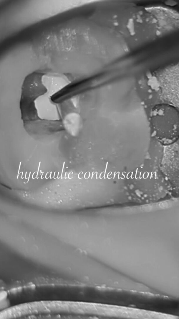 ・
・
hydraulic condensation

𓏸𓈒𓂃 clara dental clinic 🦷𓂃𓈒𓏸

やさしく、丁寧に。
お一人おひとりに寄り添う歯科診療を大切にしています。

⧉ Address
福岡県北九州市小倉北区大門1-3-13

⧉ Open days
Mon / Tue / Thu / Fri / Sat
※Saturday AM only

⧉ Hours
AM 9:00 – 13:00
PM 14:30 – 18:30

⧉ Closed
Wed / Sun / Holidays

#精密根管治療  #根管充填 #歯根端切除術 #初回根管治療 #北九州