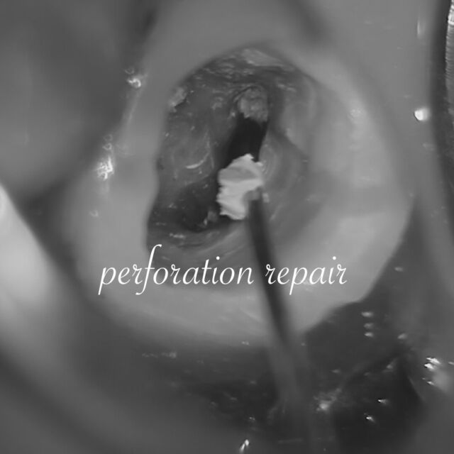 ・
・
県外からの患者様。

MTAにてパーフォレーンリペアを行ってから、通常通りの根管治療を行った症例です。

そしてDL根の病変、気を使う😳💦

𓏸𓈒𓂃 clara dental clinic 🦷𓂃𓈒𓏸

やさしく、丁寧に。
お一人おひとりに寄り添う歯科診療を大切にしています。

⧉ Address
福岡県北九州市小倉北区大門1-3-13

⧉ Open days
Mon / Tue / Thu / Fri / Sat
※Saturday AM only

⧉ Hours
AM 9:00 – 13:00
PM 14:30 – 18:30

⧉ Closed
Wed / Sun / Holidays

#精密根管治療  #外科的歯内療法　#歯根端切除術 #再根管治療 #北九州