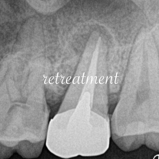 ・
・
上顎第二大臼歯は解剖学的形態のバリエーションが多い歯種です。
術前にCBCT撮影を行い、三次元的な根管形態の予測を立てておくことで根管の見逃しを防ぎ、アクセス・根管形成をスムーズに進める事ができます。

根尖部は開放状態を呈しており、アピカルストップの確立が困難であっため、MTAを用いてアピカルバリアを形成し根管充填を行った症例です。

𓏸𓈒𓂃 clara dental clinic 🦷𓂃𓈒𓏸

やさしく、丁寧に。
お一人おひとりに寄り添う歯科診療を大切にしています。

⧉ Address
福岡県北九州市小倉北区大門1-3-13

⧉ Open days
Mon / Tue / Thu / Fri / Sat
※Saturday AM only

⧉ Hours
AM 9:00 – 13:00
PM 14:30 – 18:30

⧉ Closed
Wed / Sun / Holidays

#精密根管治療  #外科的歯内療法　#歯根端切除術 #再根管治療 #北九州