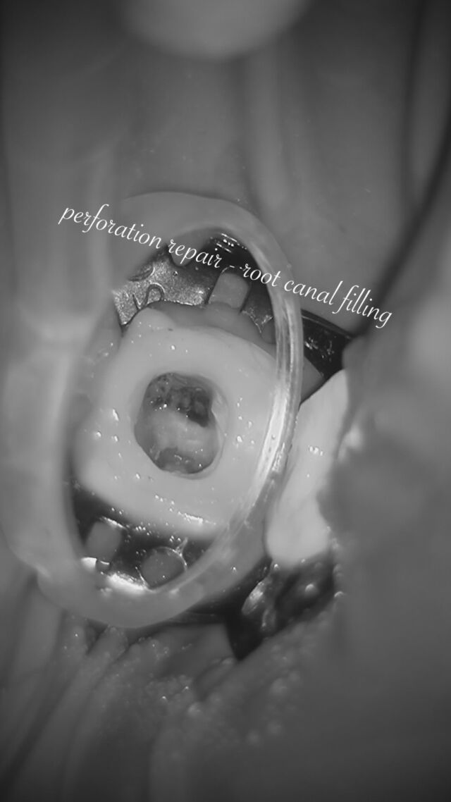 ・
・
perforation repair 〜 root canal filling

穿孔部を確認後、感染組織を徹底的に除去し、洗浄・止血を行ったうえで perforation repair を行っています。

修復材料の確実な封鎖を確認した後に、根管形成・洗浄を進め、根管充填へ。

Perforation repair では
✔︎ 正確な穿孔部位の把握
✔︎ 出血・感染コントロール
✔︎ 材料の確実な封鎖性

が重要です。

穿孔は難症例になりやすい一方、適切な診断と封鎖ができれば歯の保存につながることもあります。

#2visit #マイクロエンド #根管治療 #PerforationRepair  #MTA