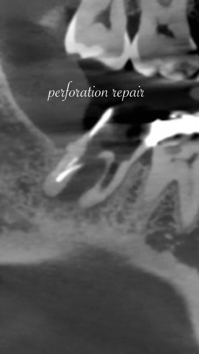 ・　
・
まずはここから🦷

#perforationrepair #bioceramicputty #マイクロエンド #福岡 #歯科