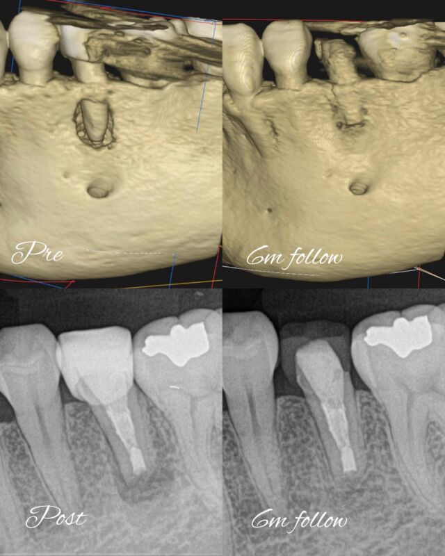 ・
・
【外科的歯内療法 / Endodontic Microsurgery】

根尖病変に対し、意図的再植ではなく歯根端切除術を選択した一例。

▫️Pre：CBCTにて頬側皮質骨の広範な骨吸収を認める。
▫️Post：根尖切除後、逆根管形成、充填
▫️6m follow：頬側骨欠損の再生・皮質骨の連続性回復を確認。根尖部透過像も縮小し、良好な治癒経過。

デンタルでも根尖部透過像の縮小と歯根膜腔の再構築が追える一方、頬側の骨再生評価はやはりCBCTでの評価が有用。

しかし、「根尖の治癒」と「歯の長期予後」はまた別の問題。
フェルールの確保や、適切な支台築造、咬合力のコントロール、そして必要に応じた被覆冠まで含めて、歯の予後を左右する因子となります。

外科的歯内療法の対象となるような歯は、そもそもの歯質量が減少しており、歯根破折（特にVRF）のリスクは、病変の治癒とは独立して存在しています。

根尖の治癒もゴールではなく、あくまで長期メインテナンスのスタート地点だと考えています。

𓏸𓈒𓂃 clara dental clinic 🦷𓂃𓈒𓏸

根管治療専門の医院です

⧉ Address
福岡県北九州市小倉北区大門1-3-13

⧉ Open days
Mon / Tue / Thu / Fri / Sat
※Saturday AM only

⧉ Hours
AM 9:00 – 13:00
PM 14:30 – 18:30

⧉ Closed
Wed / Sun / Holidays

#外科的歯内療法 #歯根端切除術 #EndodonticMicrosurgery #Apicoectomy #マイクロエンド